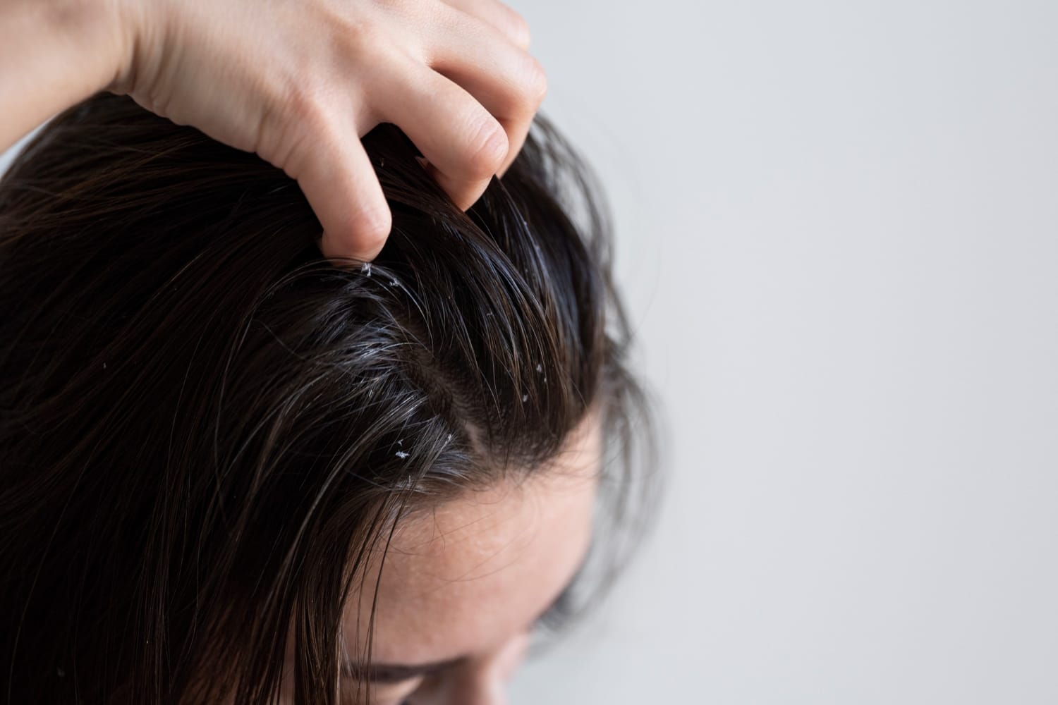 Best Home Remedies For Dandruff